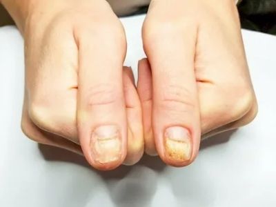 Грибок ногтей на больших пальцах