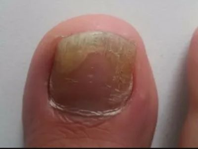 Грибок ногтя большого пальца ноги